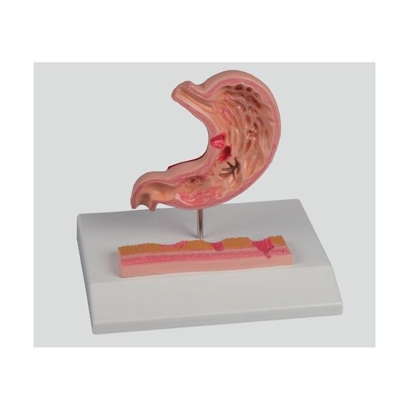 胃潰瘍モデル 120×90×20 8-8569-01 1